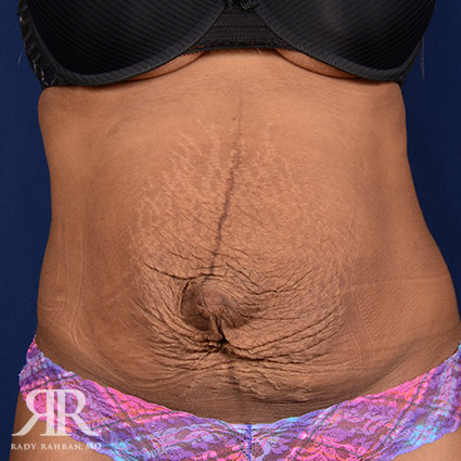 Severe Diastasis Recti