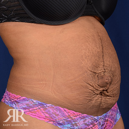 Severe Diastasis Recti