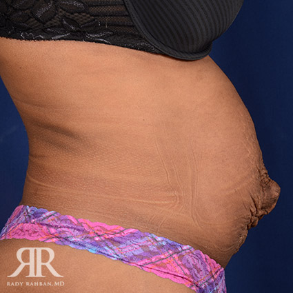 Severe Diastasis Recti