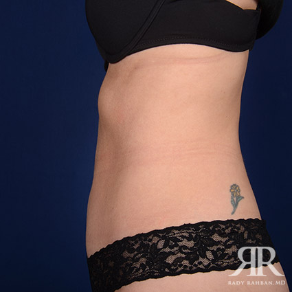 Severe Diastasis Recti