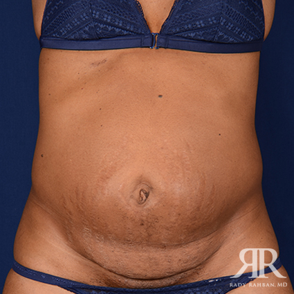 Severe Diastasis Recti