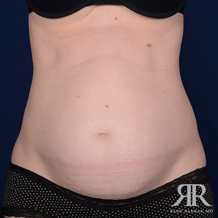 Severe Diastasis Recti