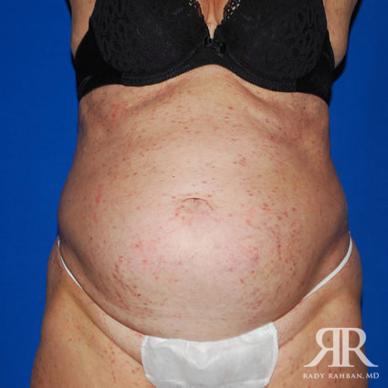 Severe Diastasis Recti