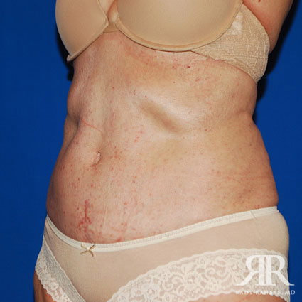 Severe Diastasis Recti