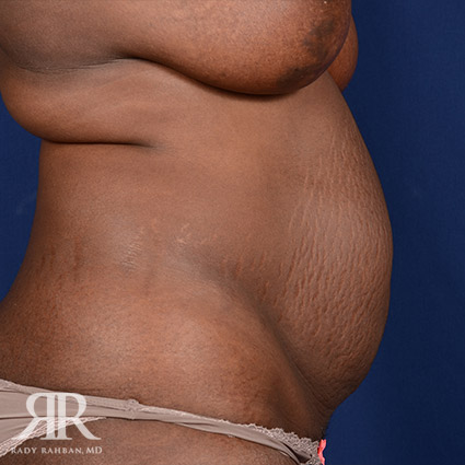 Severe Diastasis Recti