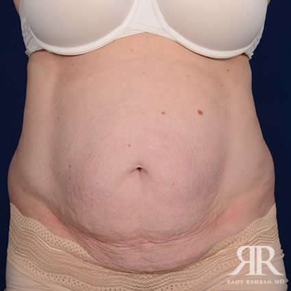 Severe Diastasis Recti