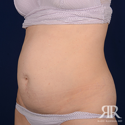 Severe Diastasis Recti