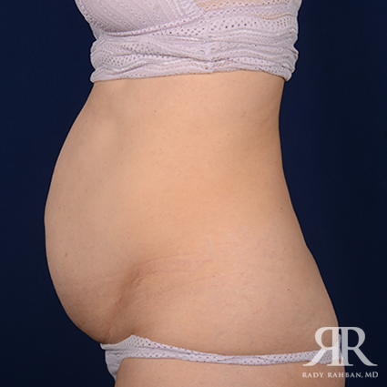 Severe Diastasis Recti