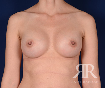 Breast Augmentation