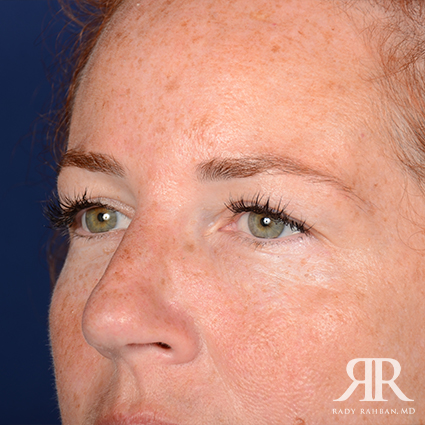 Eyelid Surgery