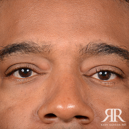 Eyelid Surgery