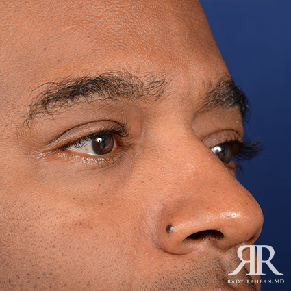 Eyelid Surgery