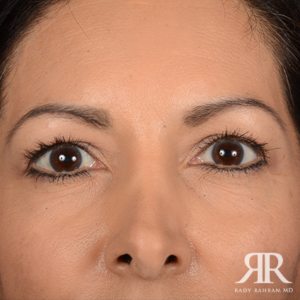 Eyelid Surgery