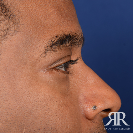 Eyelid Surgery