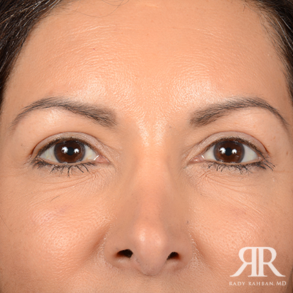 Eyelid Surgery