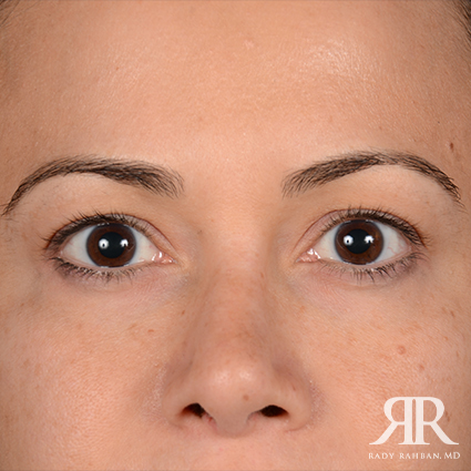 Eyelid Surgery