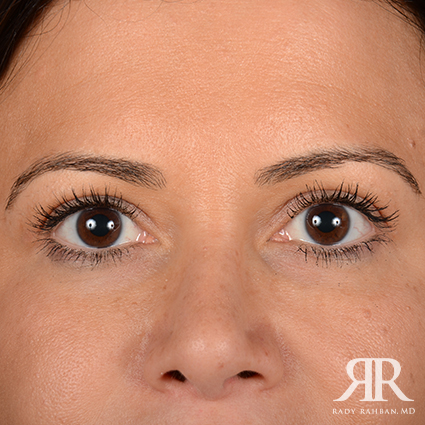 Eyelid Surgery