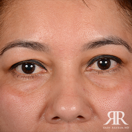 Eyelid Surgery