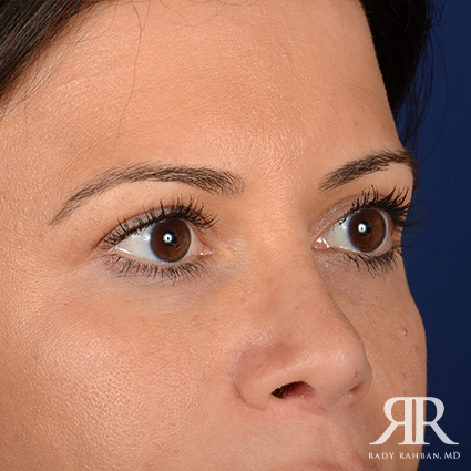 Eyelid Surgery