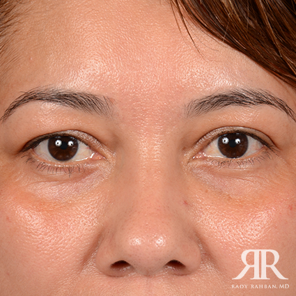 Eyelid Surgery