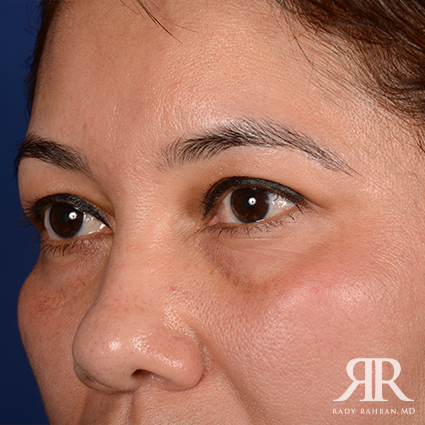 Eyelid Surgery