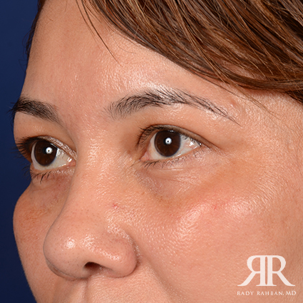 Eyelid Surgery