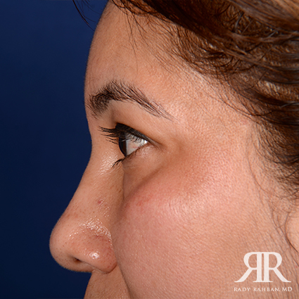 Eyelid Surgery