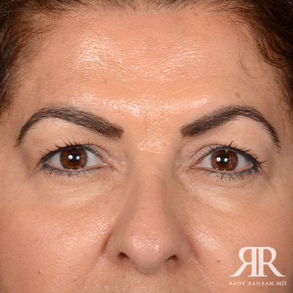 Eyelid Surgery