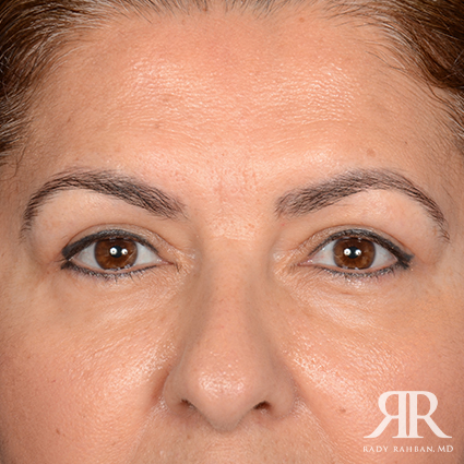 Eyelid Surgery