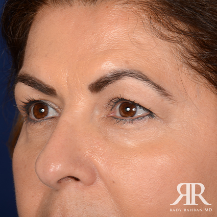 Eyelid Surgery