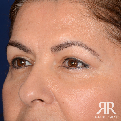 Eyelid Surgery