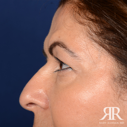 Eyelid Surgery