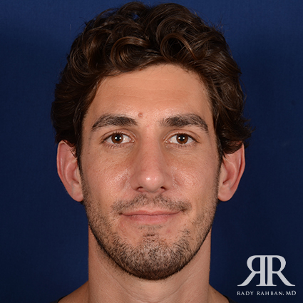 Chin Augmentation