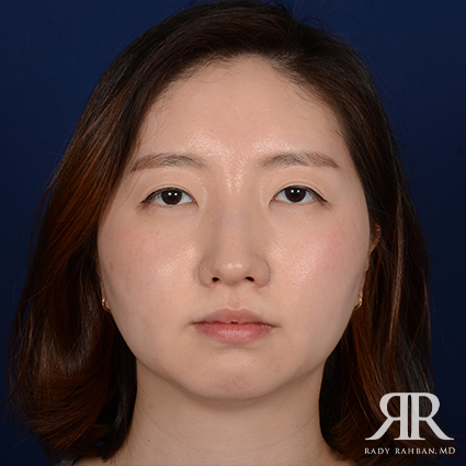 Chin Augmentation