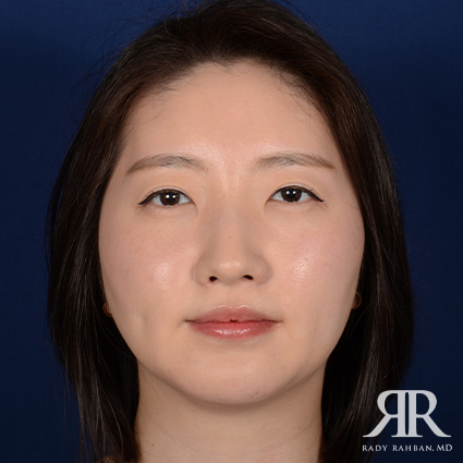 Chin Augmentation