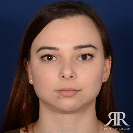 Chin Augmentation