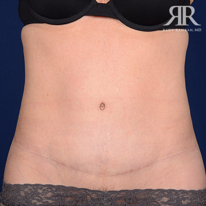 Tummy Tuck Scars Before & After