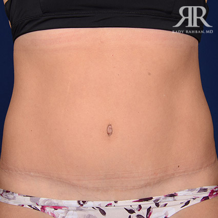 Tummy Tuck Scars