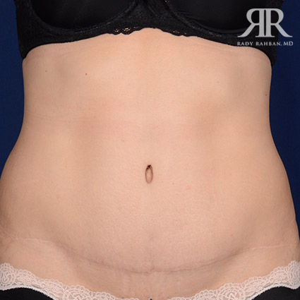 Tummy Tuck Scars