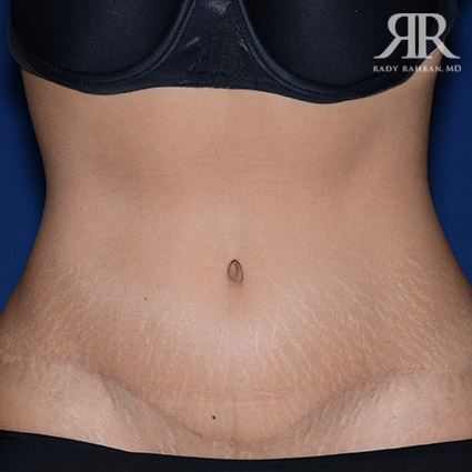 Tummy Tuck Scars Before & After, Patient 04