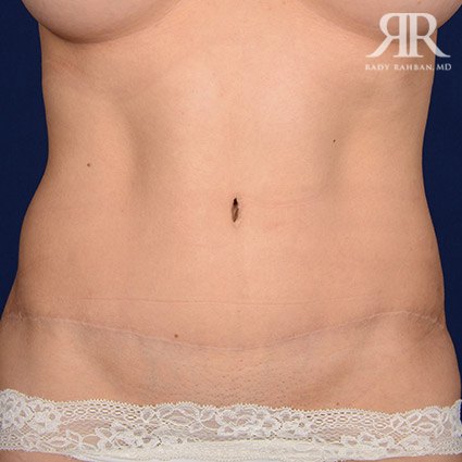 Tummy Tuck Scars