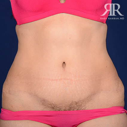 Tummy Tuck Scars