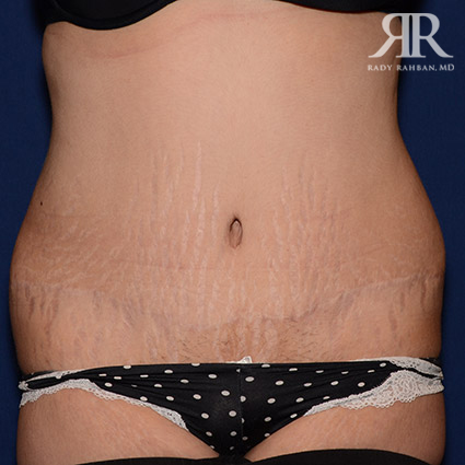 Tummy Tuck Scars