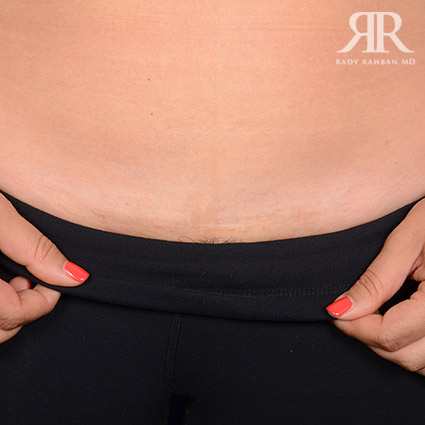 Tummy Tuck Scars