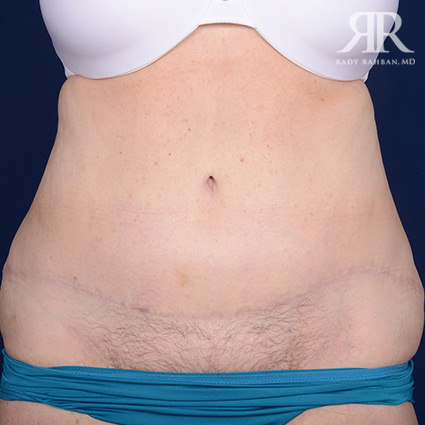 Tummy Tuck Scars