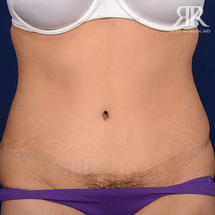 Tummy Tuck Scars