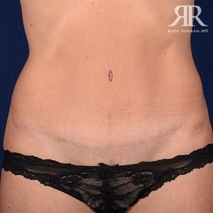 Tummy Tuck Scars