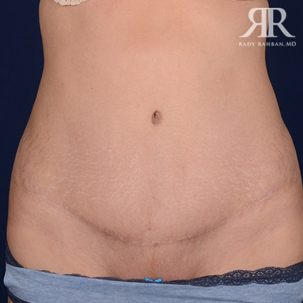 Tummy Tuck Scars Before and After Photo Gallery, Los Angeles, CA