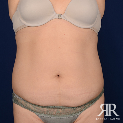 Tummy Tuck