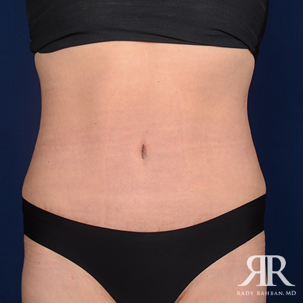 Tummy Tuck